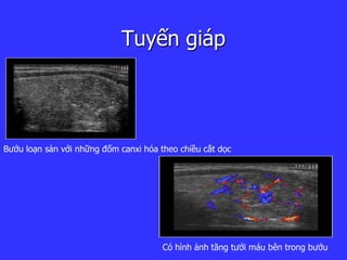 Tuyến giáp
Bướu loạn sản với những đốm canxi hóa theo chiều cắt ọc
Có hình ảnh tăng tưới máu bên trong bướu
 