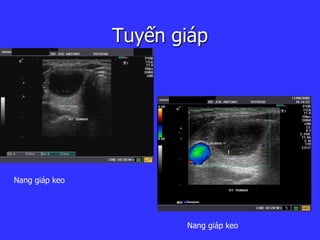Tuyến giáp
Nang giáp keo
Nang giáp keo
 