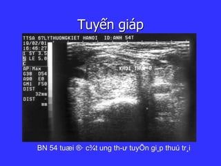 Tuyến giáp
BN 54 tuæi ®· c¾t ung th­ư tuyÕn gi¸p thuú tr¸i
 