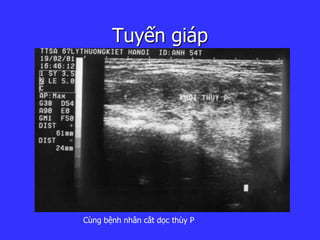 Tuyến giáp
Cùng bệnh nhân cắt ọc thùy P
 