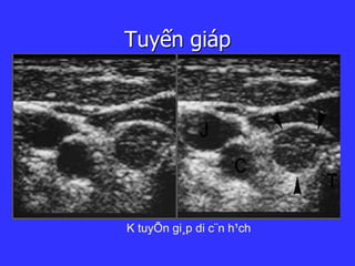 Tuyến giáp
K tuyÕn gi¸p di c¨n h¹ch
 