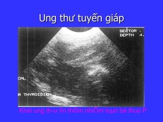 Ung thư tuyến giáp
Khèi ung th­ư lín th©m nhiÔm toµn bé thuú P
 