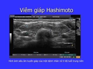 Viêm giáp Hashimoto
Hình ảnh siêu âm tuyến giáp của một bệnh nhân nữ ở độ tuổi trung niên
 