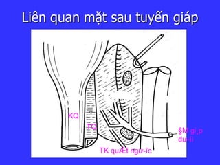 Liên quan mặt sau tuyến giáp
KQ
TQ
TK quÆt ngư­îc
§M gi¸p
dư­íi
 