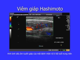 Viêm giáp Hashimoto
Hình ảnh siêu âm tuyến giáp của một bệnh nhân nữ ở độ tuổi trung niên
 
