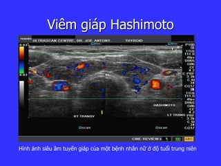 Viêm giáp Hashimoto
Hình ảnh siêu âm tuyến giáp của một bệnh nhân nữ ở độ tuổi trung niên
 