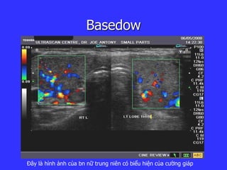 Basedow
Đây là hình ảnh của bn nữ trung niên có biểu hiện của cường giáp
 