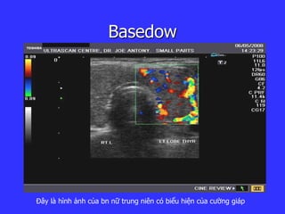 Basedow
Đây là hình ảnh của bn nữ trung niên có biểu hiện của cường giáp
 