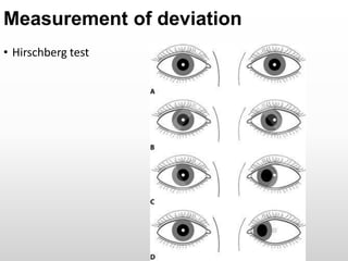 Hirschberg Test Normal Sixth and seventh cranial nerves: anatomy and disorders | PPTX