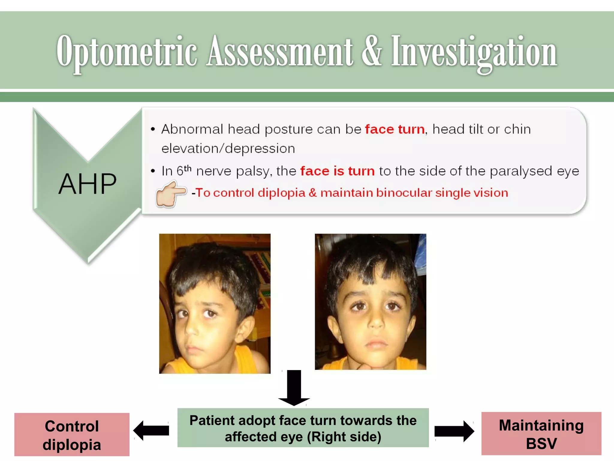 Sixth nerve palsy | PPT