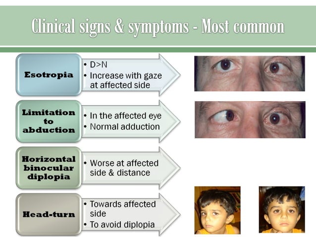 Sixth nerve palsy | PPT | Eye and Vision Conditions | Diseases and ...