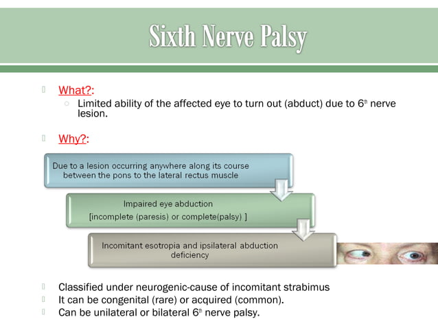 Sixth nerve palsy | PPT | Eye and Vision Conditions | Diseases and ...