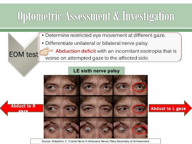 Sixth nerve palsy