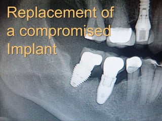 Replacement of
a compromised
Implant
 