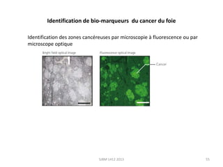 Identification de bio-marqueurs du cancer du foie
Identification des zones cancéreuses par microscopie à fluorescence ou par
microscope optique

SJBM 1412 2013

55

 