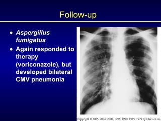 Follow-up  Aspergillus fumigatus  Again responded to therapy (voriconazole), but developed bilateral CMV pneumonia 