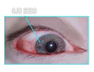 Sjögren Sindrome de