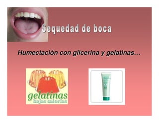 Sjögren Sindrome de