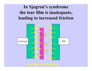 Sjögren Sindrome de