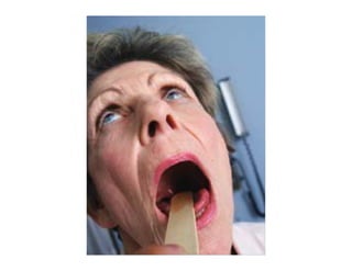 Sjögren Sindrome de