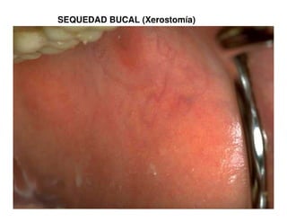 Sjögren Sindrome de