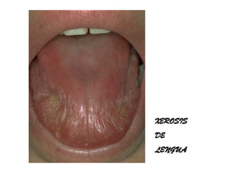 Sjögren Sindrome de