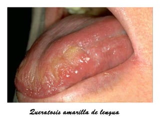 Sjögren Sindrome de