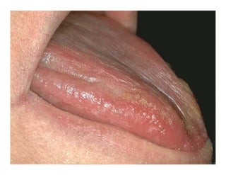 Sjögren Sindrome de