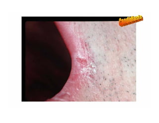 Sjögren Sindrome de