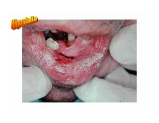 Sjögren Sindrome de