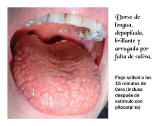 Sjögren Sindrome de