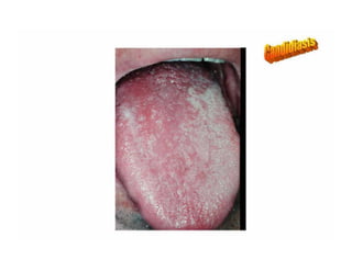 Sjögren Sindrome de