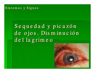 Sjögren Sindrome de