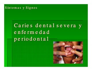 Sjögren Sindrome de