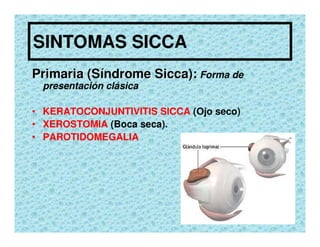 Sjögren Sindrome de