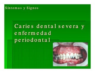 Sjögren Sindrome de