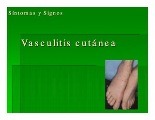 Sjögren Sindrome de