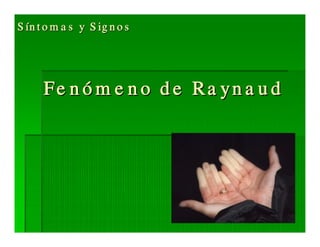 Sjögren Sindrome de