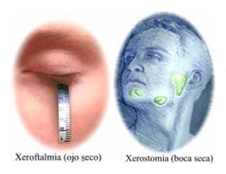 Sjögren Sindrome de