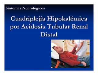 Sjögren Sindrome de