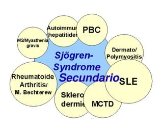 Sjögren Sindrome de