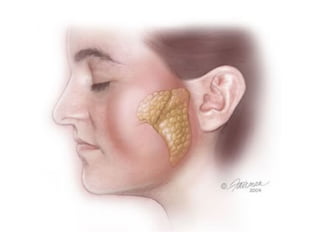 Sjögren Sindrome de