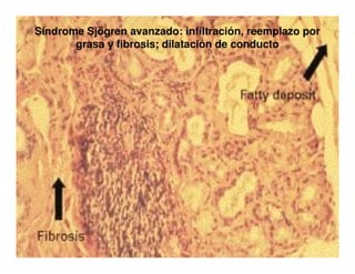 Sjögren Sindrome de