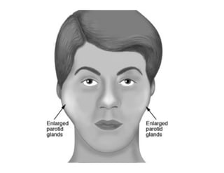 Sjögren Sindrome de