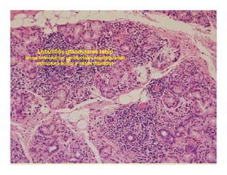 Sjögren Sindrome de