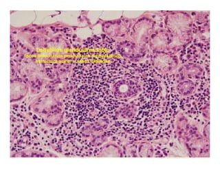 Sjögren Sindrome de