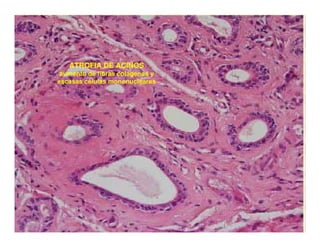 Sjögren Sindrome de