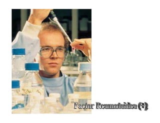 Sjögren Sindrome de