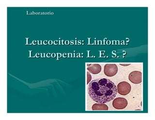 Sjögren Sindrome de