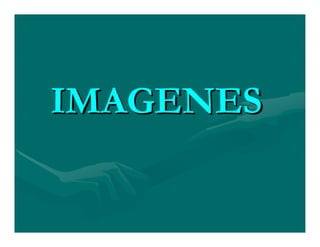 Sjögren Sindrome de